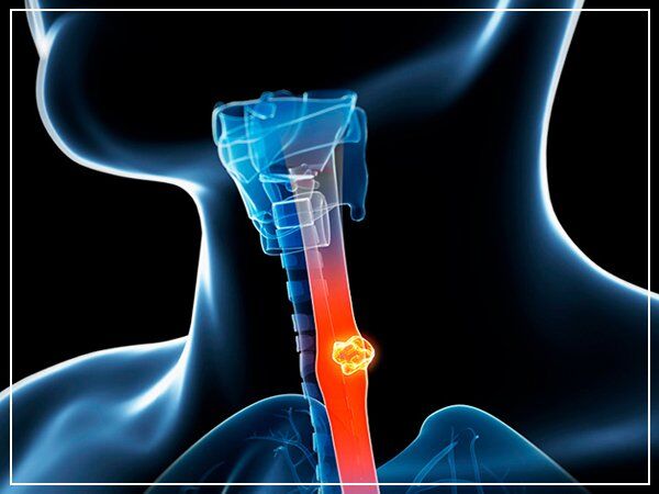 Lucknow, Health, Expert Esophageal Cancer Doctor In Noida | Cancer Consult