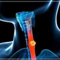 Expert Esophageal Cancer Doctor In Noida | Cancer Consult