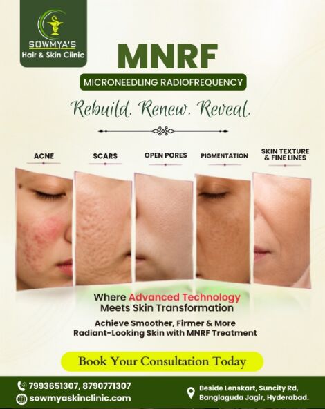 Hyderabad, Health, Best Skin Doctor In Suncity, Hyderabad For Advanced MNRF Treatment