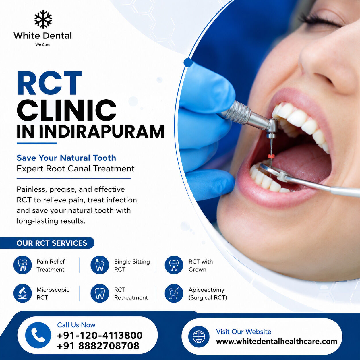 Ghaziabad, Dental, RCT Clinic In Indirapuram For Root Canal Care