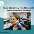 Can A Completely Torn Ear Lobe Be Repaired Without Stitches?