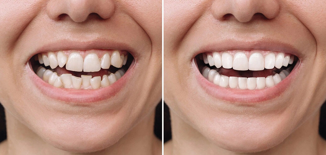 New York, Dental, Can You Get Veneers With Crooked Teeth? Here
