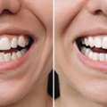 Can You Get Veneers With Crooked Teeth? Here's The Truth