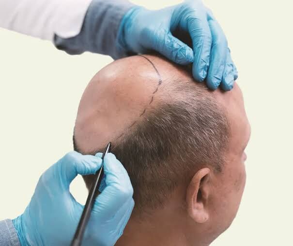 New Delhi, Health, Get Smooth Scalp, Fuller Hair With The Botox Hair Treatment!