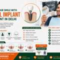 Dental Implant Cost In Delhi | Affordable & Advanced Dental Implants At Abha Care