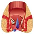 Piles Treatment In Delhi NCR &ndash; Metropiles Clinic