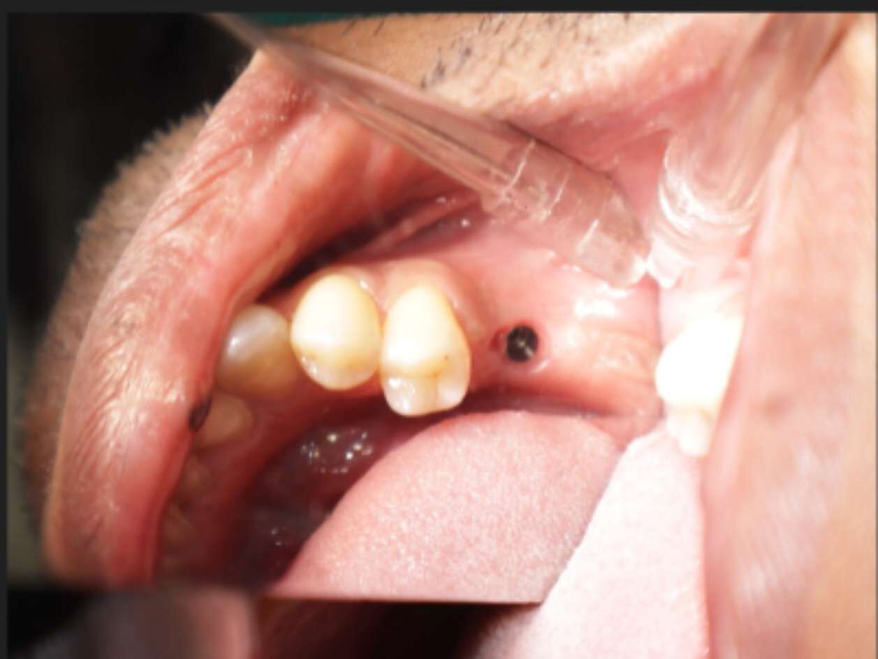 Kolkata, General, Trusted Dental Implant Care At AB Dentologic &ndash; Newtown
