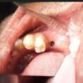 Trusted Dental Implant Care At AB Dentologic &ndash; Newtown