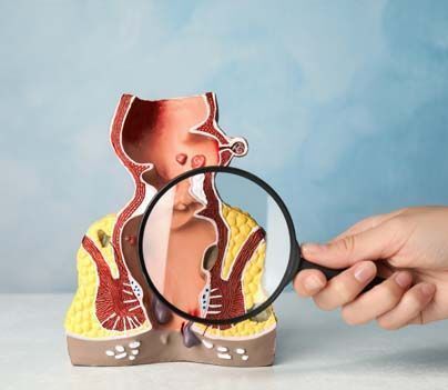 New Delhi, Health, Fissure Treatment In Kalkaji &ndash; Metropiles Clinic
