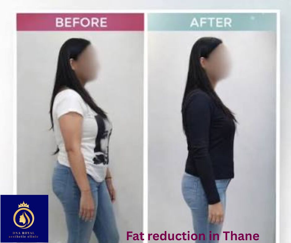 Thane, Fashion & Design, Achieve Your Body Goals With Fat Reduction In Thane &ndash; DNA Royal.