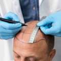 Hair Transplant In Varanasi: What Should You Know Before Treatment?