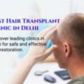 Best Hair Transplant Clinic In Delhi: Expert Tips For Making The Right Choice