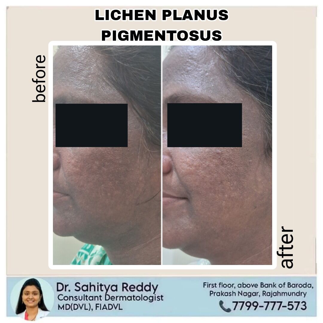 Kurnool, Health, Lichen Planus Treatment At Dermacure Clinic - Rajahmundry