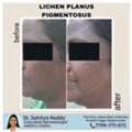 Lichen Planus Treatment At Dermacure Clinic - Rajahmundry
