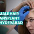 Understanding Female Pattern Hair Loss: Transplant Solutions In Hyderabad