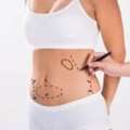 Body Contouring Tummy Tuck In Baner  - The Aesthetic Hub