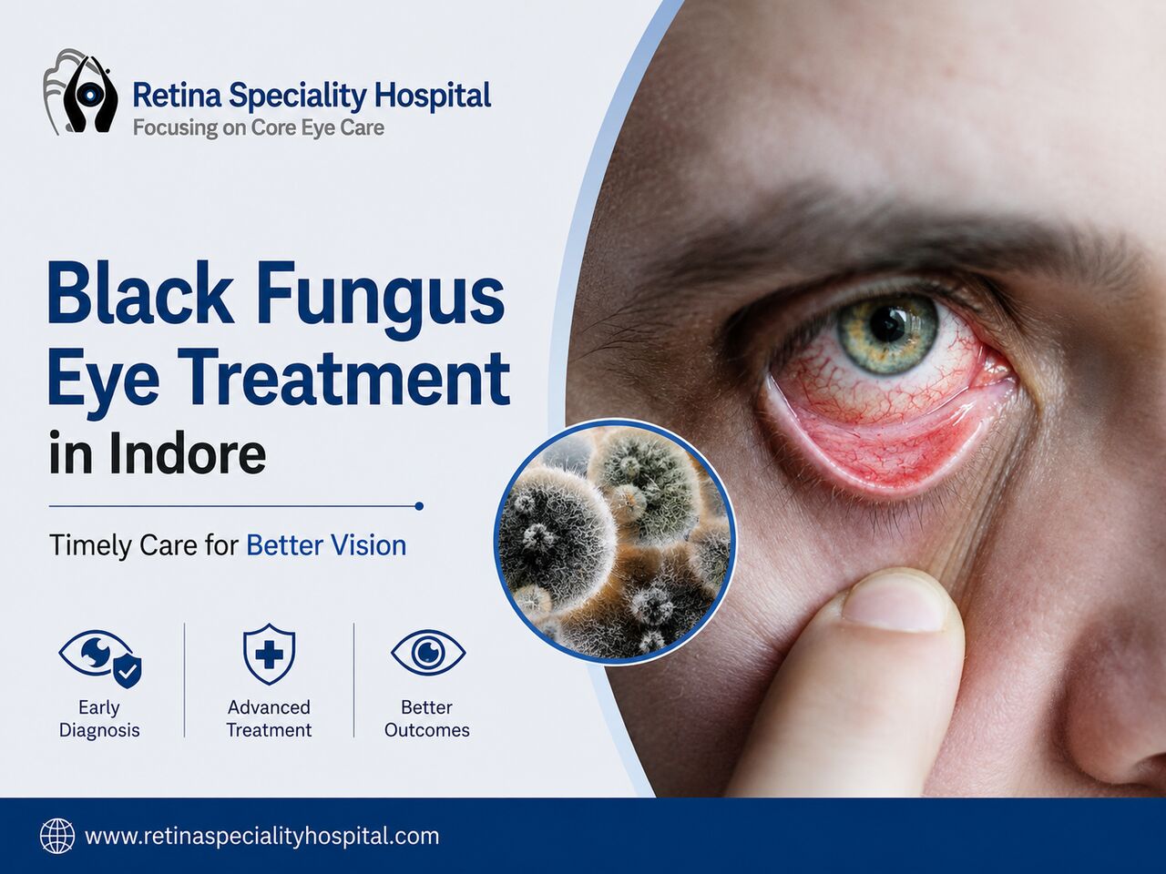 Indore, Health, Black Fungus Eye Treatment In Indore: Expert Diagnosis And Care!!