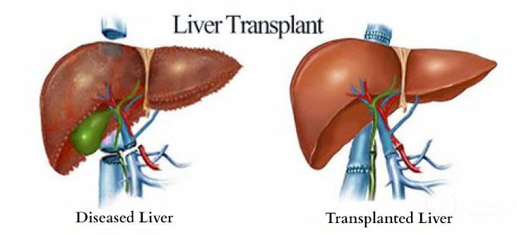 Gurgaon, Health, Liver Transplant In India | Expert Care With MyCure Pathway