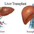 Liver Transplant In India | Expert Care With MyCure Pathway