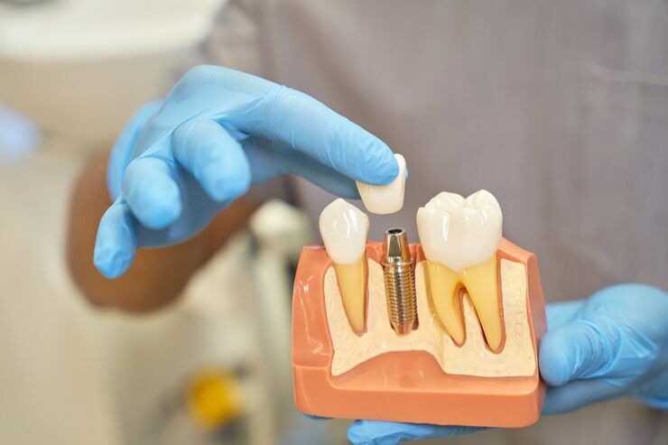 New York, Health, Dental Implants Near You For A Confident, Natural-Looking Smile