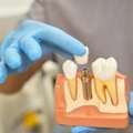 Dental Implants Near You For A Confident, Natural-Looking Smile