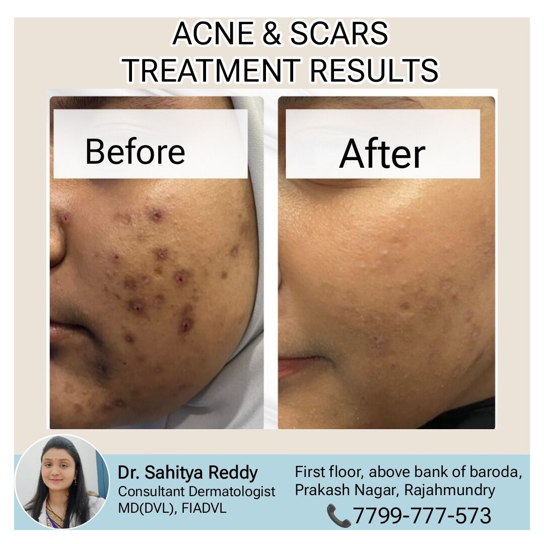 Kurnool, Health, Best Acne & Scars Treatment At Dermacure - Rajahmundry