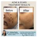 Best Acne & Scars Treatment At Dermacure - Rajahmundry