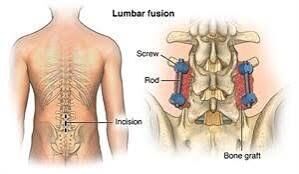 Gurgaon, Businesses For Sale, Lumbar Spinal Stenosis Treatment In Gurgaon : Effective Treatment For Professional Physiot