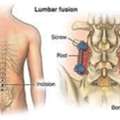 Lumbar Spinal Stenosis Treatment In Gurgaon : Effective Treatment For Professional Physiot