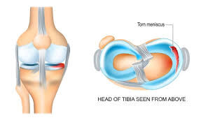 Gurgaon, Businesses For Sale, Meniscus Injury In Gurgaon : Repairing Mobility Using The Highest Level Of Precision
