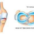Meniscus Injury In Gurgaon : Repairing Mobility Using The Highest Level Of Precision
