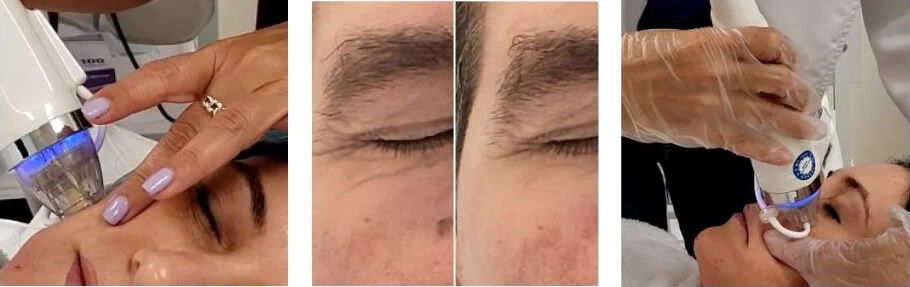 New York, Wholesale Products, Skin Tightening Champaign | Refresh Your Natural Look