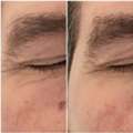 Skin Tightening Champaign | Refresh Your Natural Look