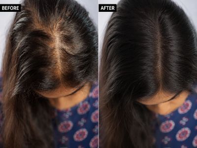Kolkata, General, The Aesthetic House &ndash; Advanced Hair Care & Hair Restoration In Rajarhat