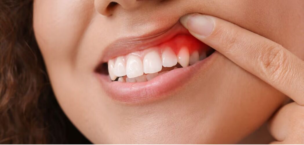 New York, Dental, Why Is My Gum Red? Common Causes & Care