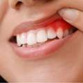 Why Is My Gum Red? Common Causes & Care
