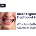Clear Aligners Vs. Traditional Braces - Meta Clinic Dubai