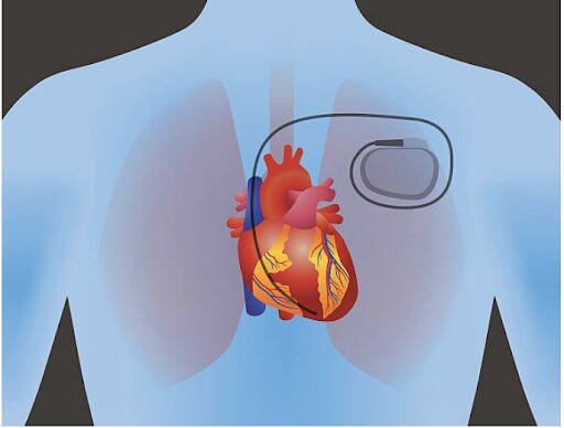 Dubai, Health, Pacemaker Operation In UAE For Heart Rhythm Disorders