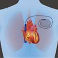 Pacemaker Operation In UAE For Heart Rhythm Disorders