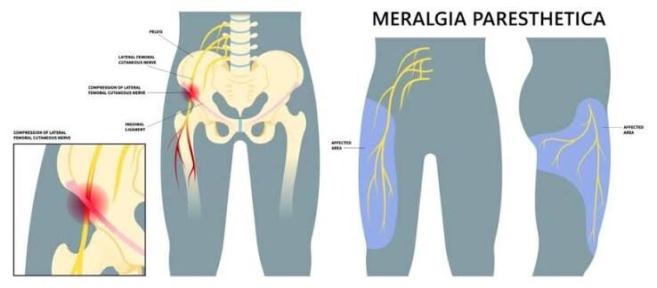 Gurgaon, Businesses For Sale, Meralgia Paresthetica Treatment In Gurgaon : Expert Physiotherapists In Gurgaon