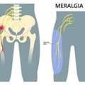 Meralgia Paresthetica Treatment In Gurgaon : Expert Physiotherapists In Gurgaon