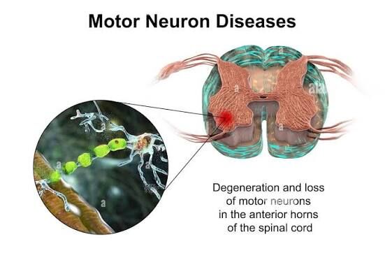 Gurgaon, Businesses For Sale, Motor Neuron Disease Treatment In Gurgaon : Expert Physiotherapy Services For Motor Neuron