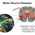 Motor Neuron Disease Treatment In Gurgaon : Expert Physiotherapy Services For Motor Neuron