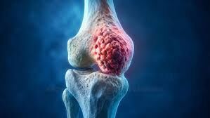 Ghaziabad, Health & Beauty Items, Expert Bone Cancer Treatment In Noida | Dr. Manish Singhal