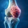 Expert Bone Cancer Treatment In Noida | Dr. Manish Singhal