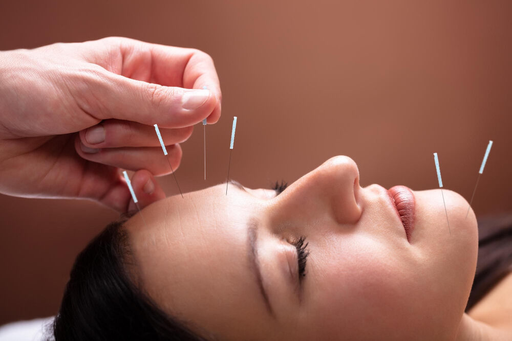 Miami, Health, Acupuncture Miami Beach, FL: Personalized Care For Your Wellness Goals