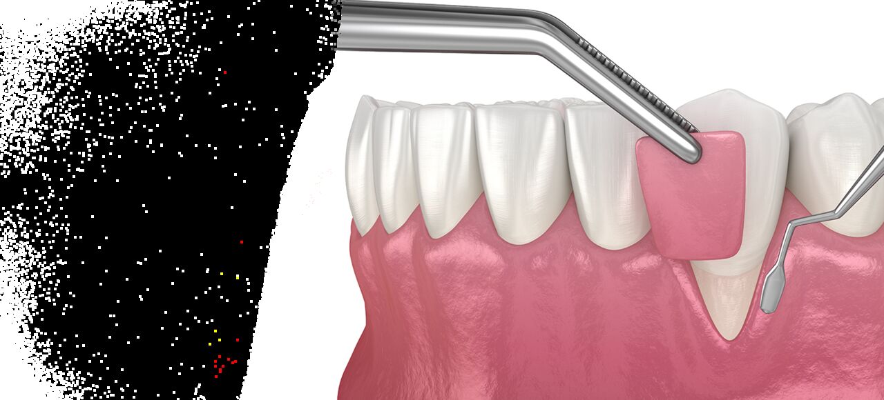 Thane, Dental, Advanced Gum Care At Agrawal Dental Clinic