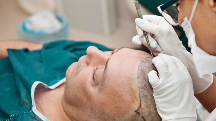 Chandigarh, Health, Expert Hair Transplant Surgeon In Chandigarh For Natural-Looking Results
