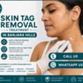 INR 1000,  Skin Tag Removal Treatment Near Jubilee Hills & Banjara Hills