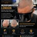 Scalp Micropigmentation London &ndash; Expert Hair Pigmentation
